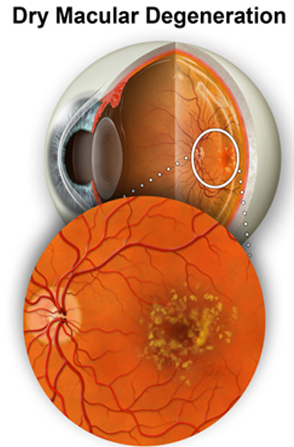 Clinical Image - Dry Macular Degeneration